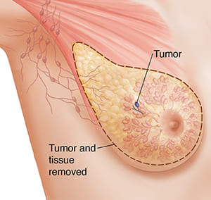 Breast-conservation-remove-the-lump-with-surrounding-normal-breast-tissue
