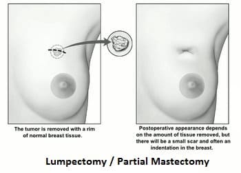 Breast-conserving-surgery-Lumpectomy-in-thane