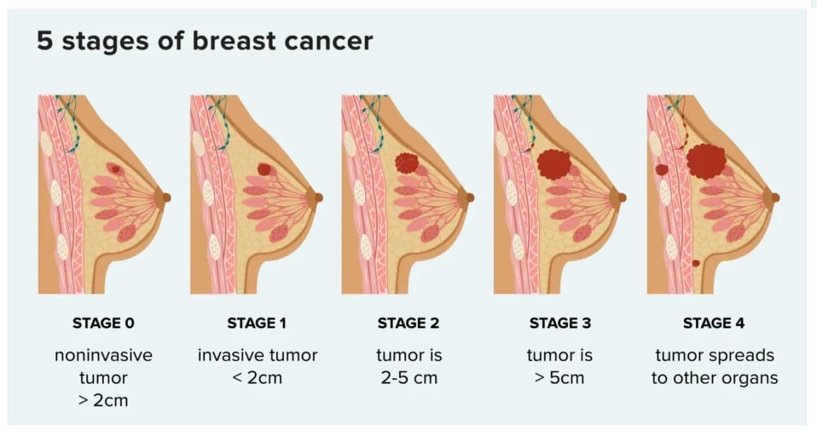 HOW-SHOULD-I-DETECT-BREAST-CANCER