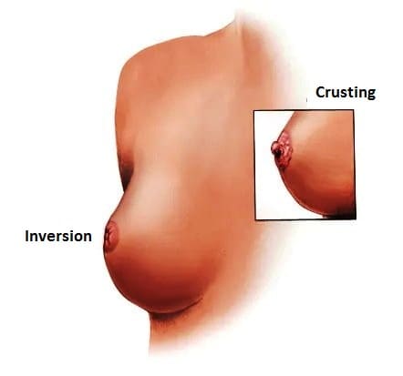 Nipple-changes-breast-cancer