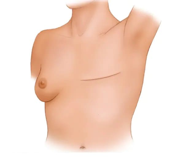 Post-mastectomy-complete-breast-removal